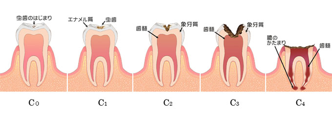 虫歯の進み方