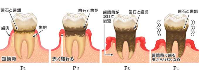 歯周病の進み方