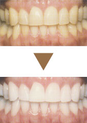 過酸化尿素を使ったホワイトニング